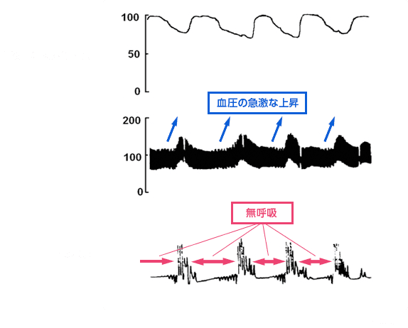 睡眠時無呼吸症候群は高血圧の原因