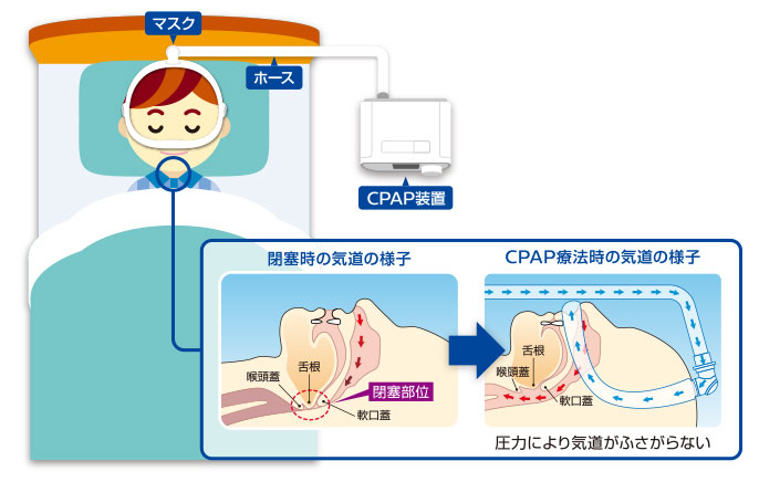CPAP（シーパップ）治療方法のイラスト